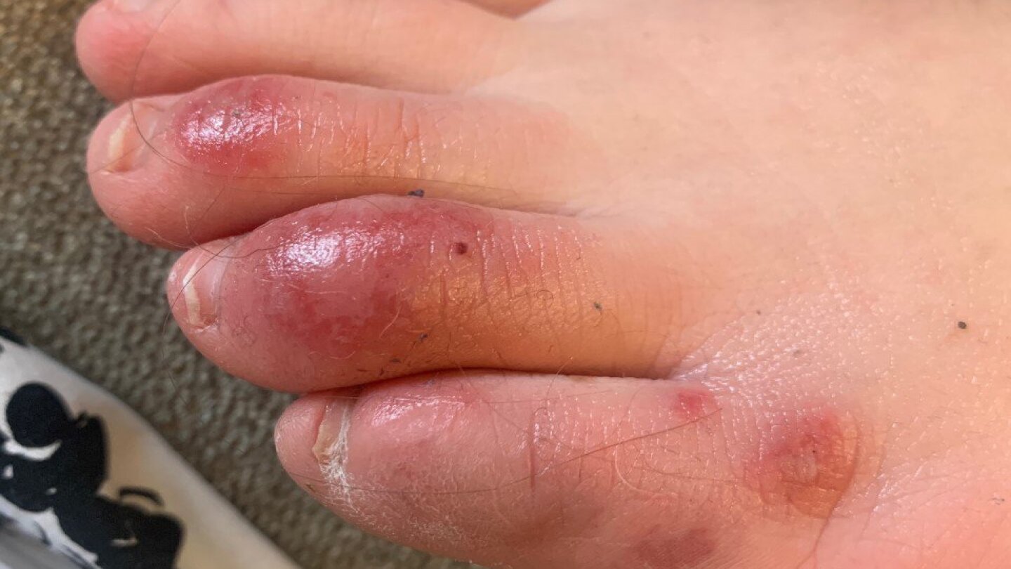 Dry store itchy toes